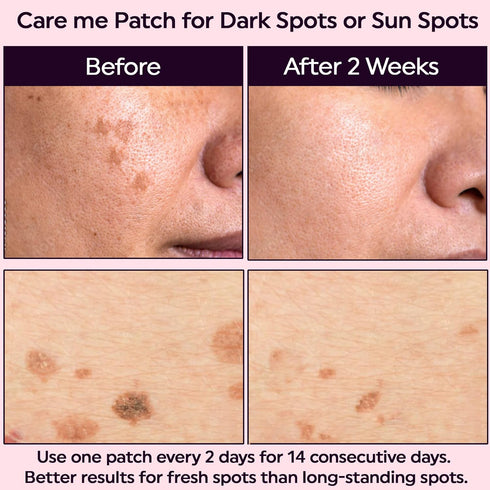 Micropoints for Acne Dark Spot Treatment, 127 Mircropoints Post-Blemish Dark Spots Removal Patch (9 count/pack)