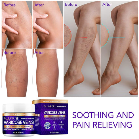 Varicose Vein Cream for Legs - Improves Blood Circulation, Reduces Spider Veins and Heaviness, 2 Oz