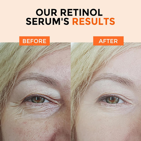 Retinol Serum 2.5% for Face, B5 Resurfacing with Vitamin C, E, Hyaluronic Acid, Anti-Aging, Dark Spot Corrector