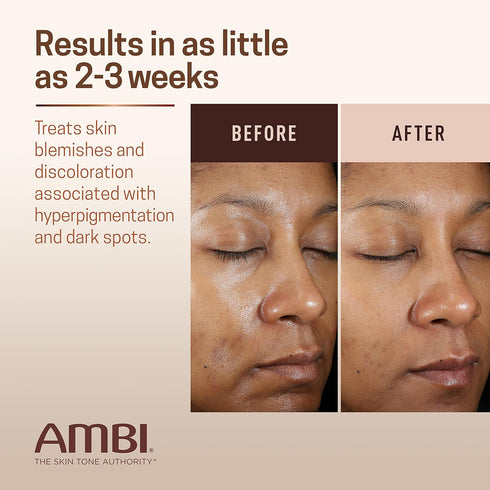 Ambi Even & Clear Fade Cream, Hydroquinone-free, Hyperpigmentation Treatment, Dark Spot Corrector, 1 Fl Oz