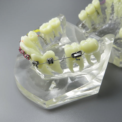 Dental Malocclusion Orthodontic Treatment Teeth Model with Metal Brackets, Colorful Ties, and Chains