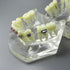 Dental Malocclusion Orthodontic Treatment Teeth Model with Metal Brackets, Colorful Ties, and Chains